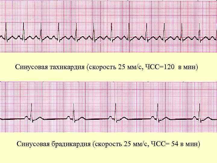 Синусовая тахикардия (скорость 25 мм/c, ЧСС=120 в мин) Синусовая брадикардия (скорость 25 мм/c, ЧСС=