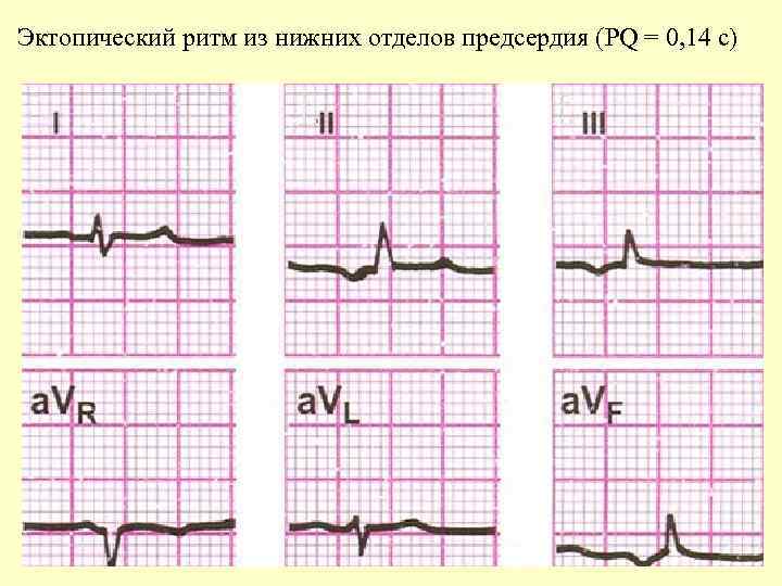 Эктопический ритм из нижних отделов предсердия (PQ = 0, 14 с) 