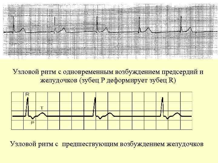 Узловой ритм сердца возникает когда роль водителя ритма берет на себя