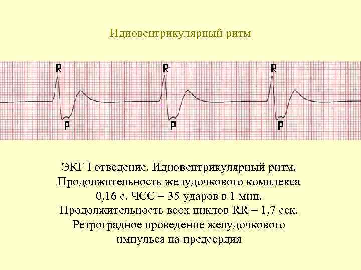 Идиовентрикулярный ритм ЭКГ I отведение. Идиовентрикулярный ритм. Продолжительность желудочкового комплекса 0, 16 с. ЧСС