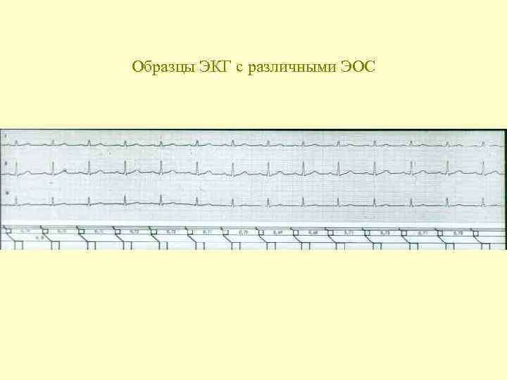 Образцы ЭКГ с различными ЭОС 