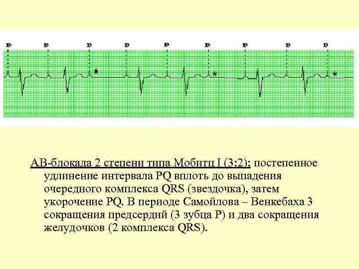 АВ-блокада 2 степени типа Мобитц I (3: 2): постепенное удлинение интервала PQ вплоть до