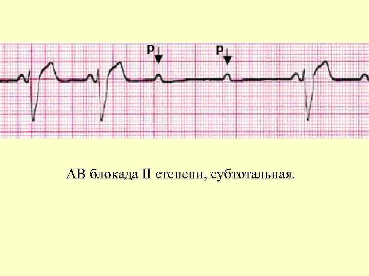 АВ блокада II степени, субтотальная. 