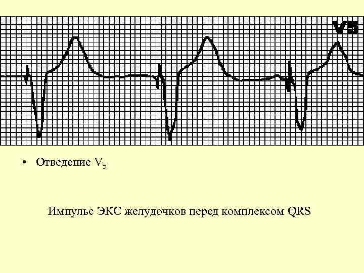  • Отведение V 5 Импульс ЭКС желудочков перед комплексом QRS 