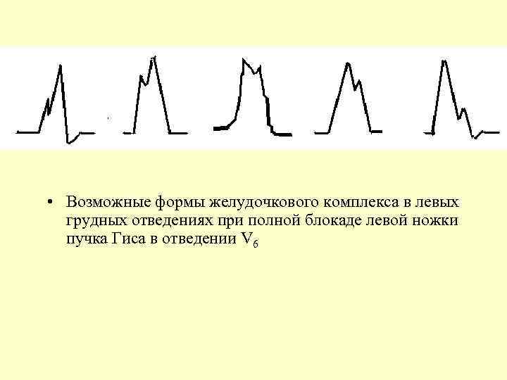  • Возможные формы желудочкового комплекса в левых грудных отведениях при полной блокаде левой