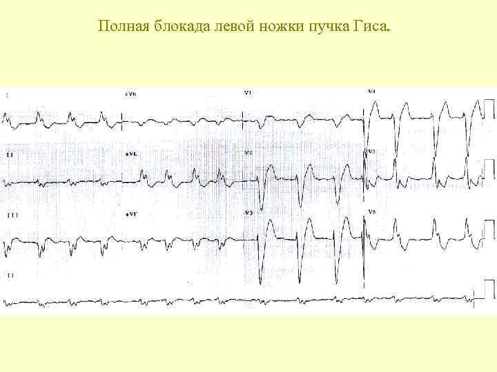 Полная блокада левой ножки пучка Гиса. 