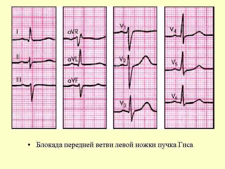  • Блокада передней ветви левой ножки пучка Гиса 