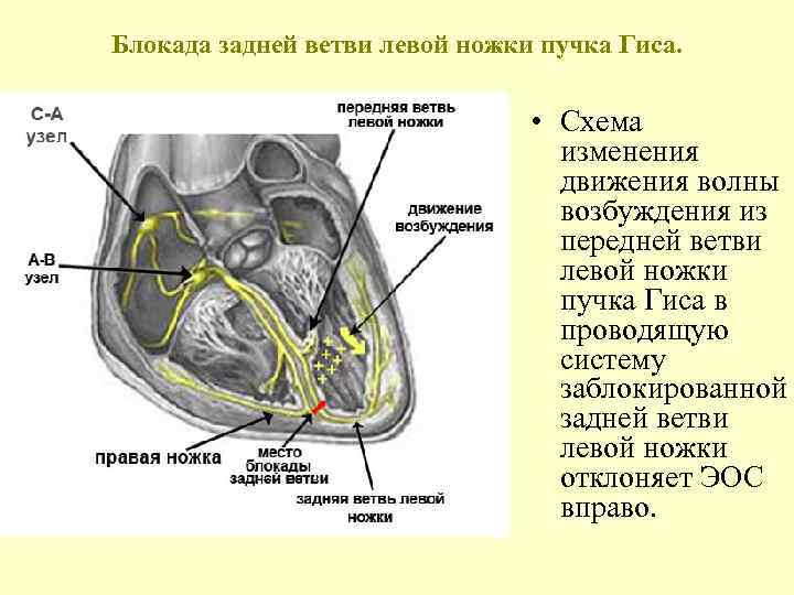Блокада задней ветви левой ножки пучка Гиса. • Схема изменения движения волны возбуждения из