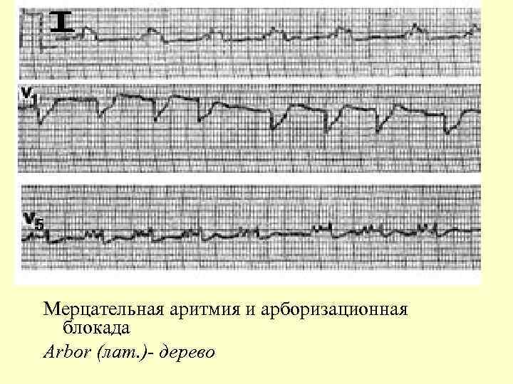Мерцательная аритмия и арборизационная блокада Arbor (лат. )- дерево 