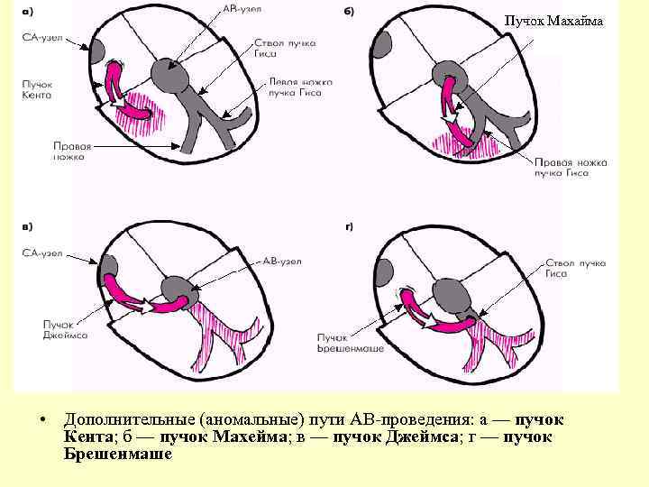 Пучок Махайма • Дополнительные (аномальные) пути АВ-проведения: а — пучок Кента; б — пучок