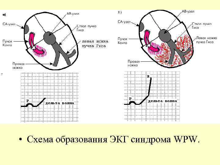  • Схема образования ЭКГ синдрома WPW. 