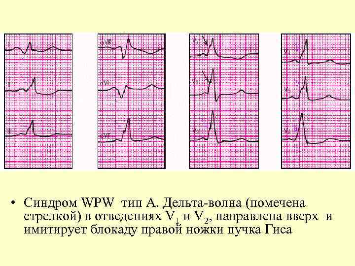  • Синдром WPW тип А. Дельта-волна (помечена стрелкой) в отведениях V 1 и