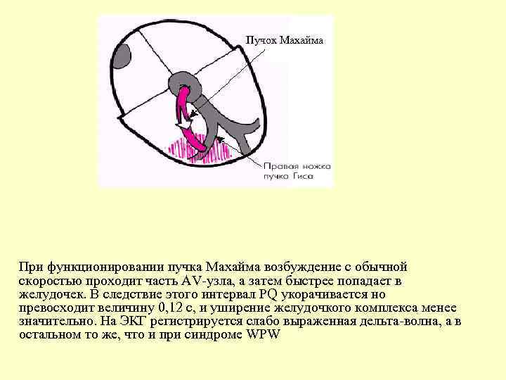 Пучок Махайма При функционировании пучка Махайма возбуждение с обычной скоростью проходит часть АV-узла, а