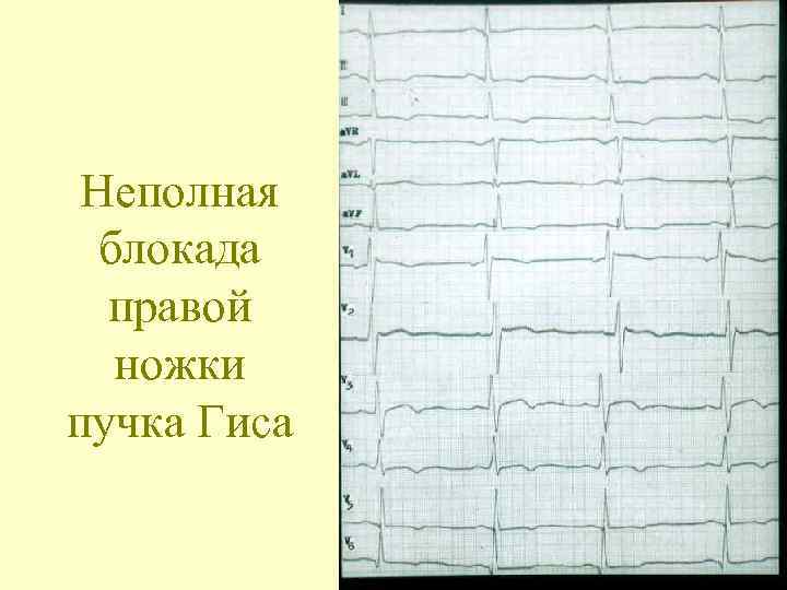 Неполная блокада правой ножки пучка Гиса 