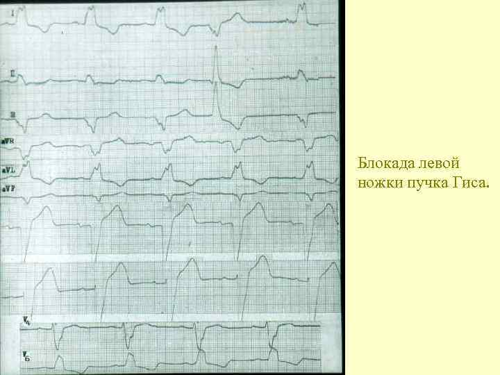Блокада левой ножки пучка Гиса. 