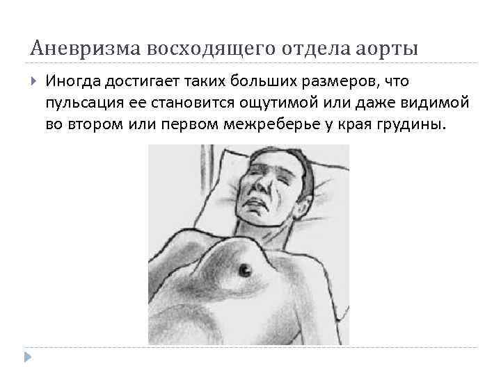 Аневризма восходящего отдела аорты Иногда достигает таких больших размеров, что пульсация ее становится ощутимой