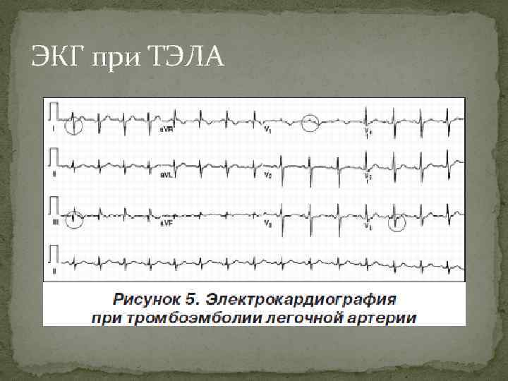 ЭКГ при ТЭЛА 