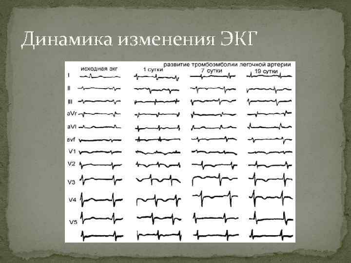 Динамика изменения ЭКГ 