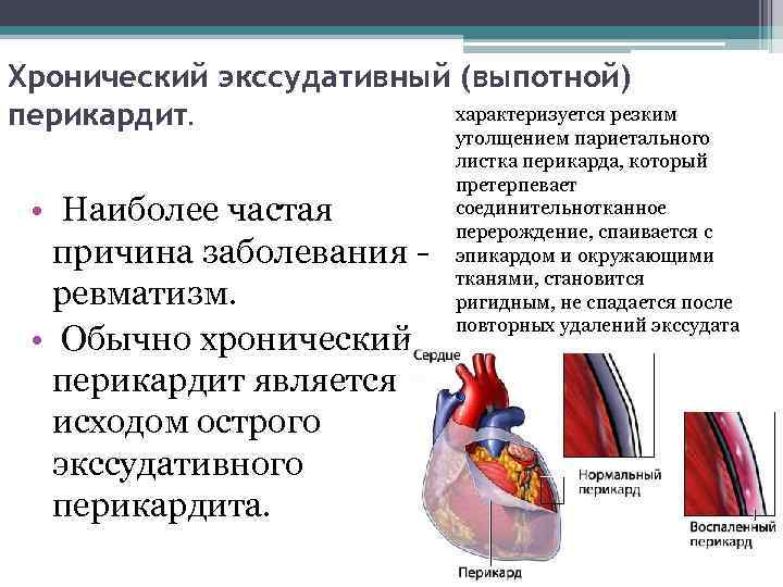 Хронический экссудативный (выпотной) характеризуется резким перикардит. • Наиболее частая причина заболевания ревматизм. • Обычно