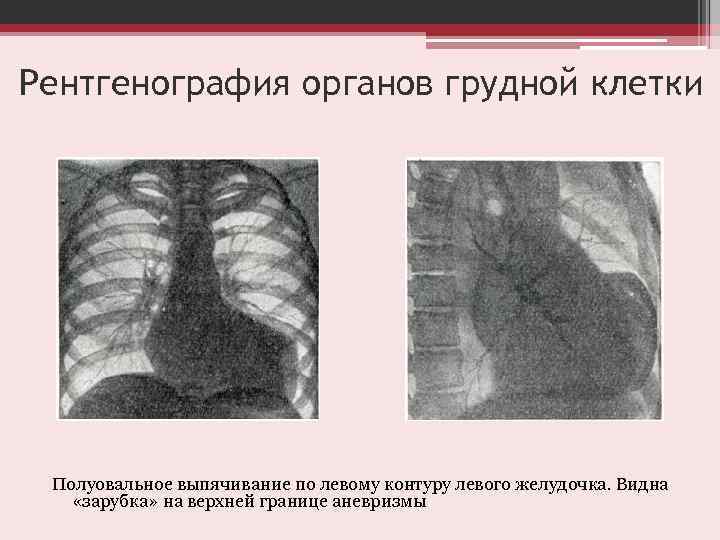 Рентгенография органов грудной клетки Полуовальное выпячивание по левому контуру левого желудочка. Видна «зарубка» на