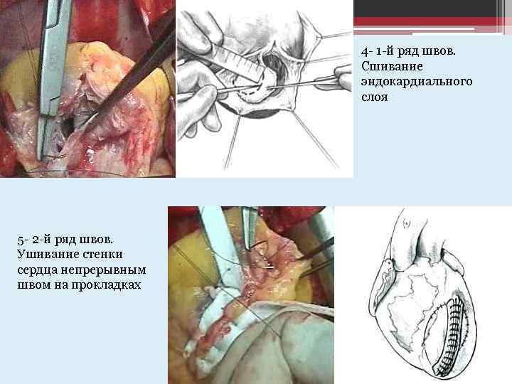4 - 1 -й ряд швов. Сшивание эндокардиального слоя 5 - 2 -й ряд