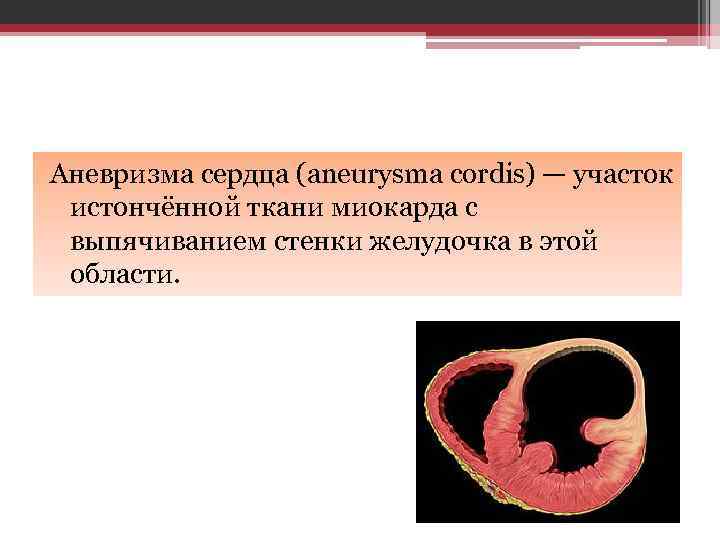 Аневризма сердца (aneurysma cordis) — участок истончённой ткани миокарда с выпячиванием стенки желудочка в