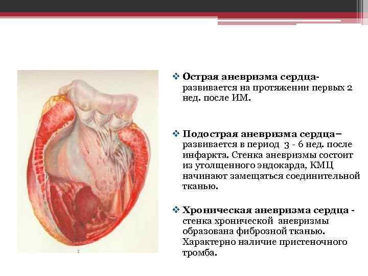 v Острая аневризма сердцаразвивается на протяжении первых 2 нед. после ИМ. v Подострая аневризма