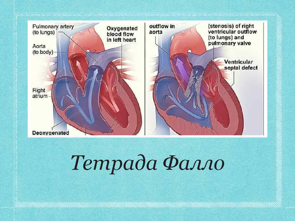 Порок тетрада фалло