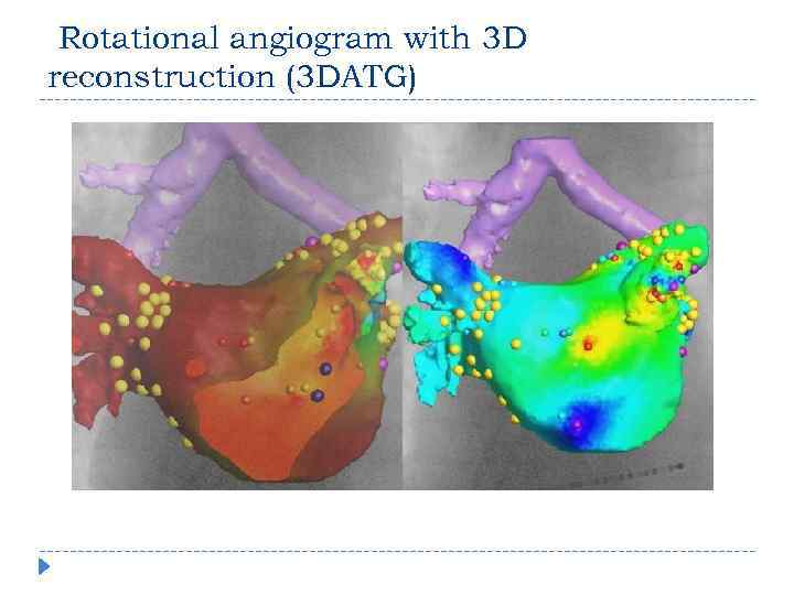  Rotational angiogram with 3 D reconstruction (3 DATG) 