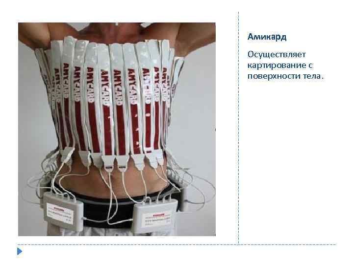 Амикард Осуществляет картирование с поверхности тела. 