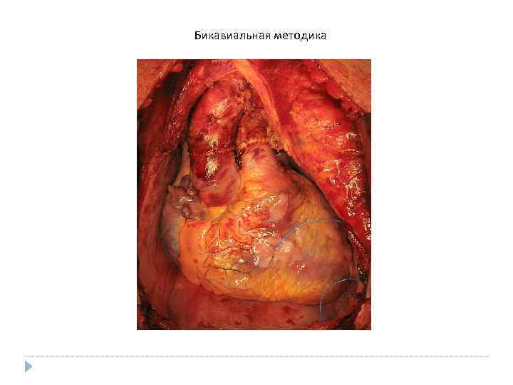  Бикавиальная методика 