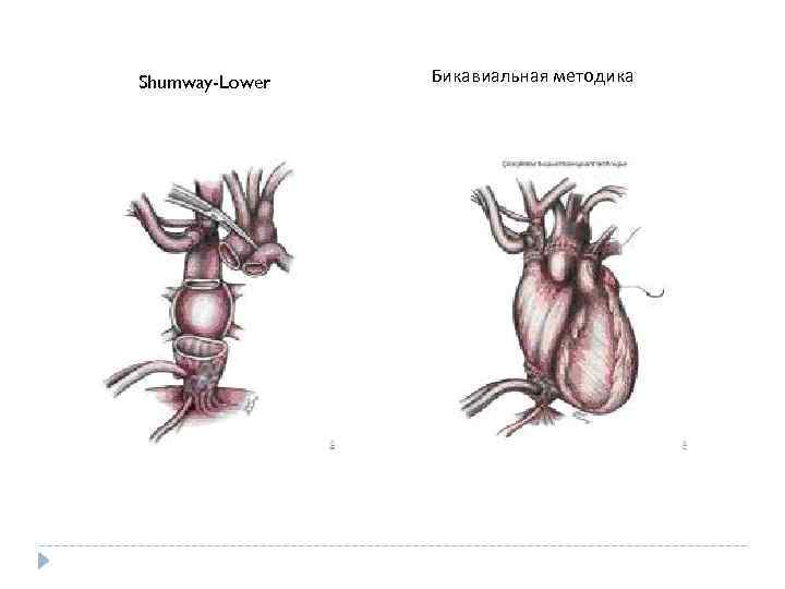 Shumway-Lower Бикавиальная методика 