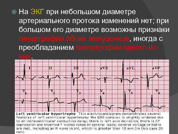  На ЭКГ при небольшом диаметре артериального протока изменений нет; при большом его диаметре
