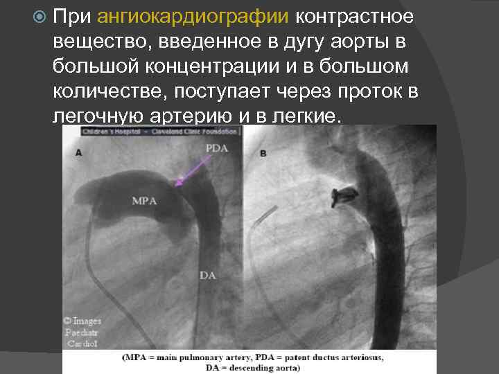  При ангиокардиографии контрастное вещество, введенное в дугу аорты в большой концентрации и в