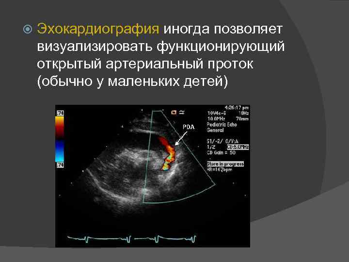 Открытый артериальный проток фото
