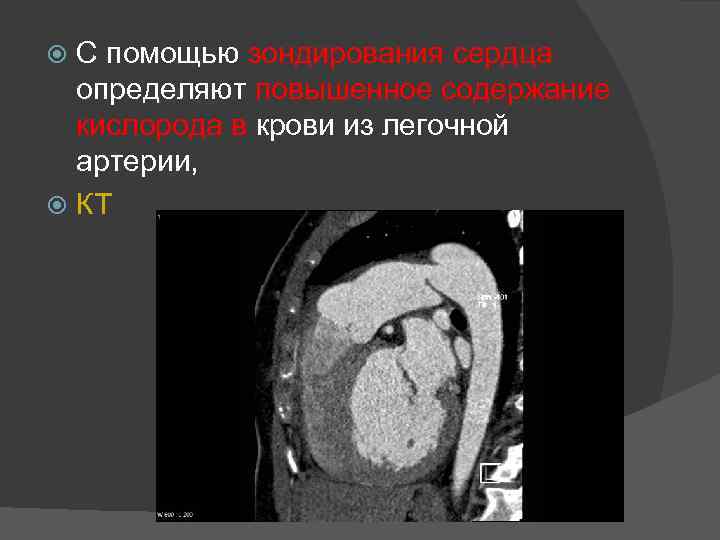 С помощью зондирования сердца определяют повышенное содержание кислорода в крови из легочной артерии, КТ