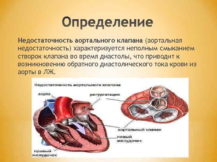 Недостаточность аортального клапана (аортальная недостаточность) характеризуется неполным смыканием створок клапана во время диастолы, что