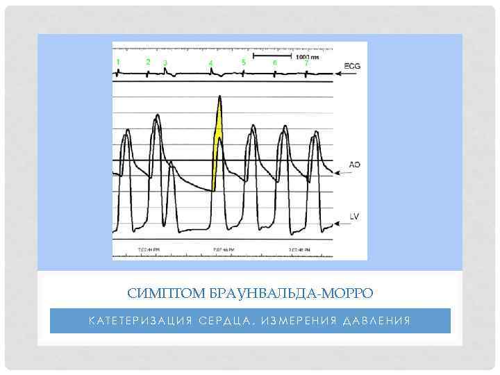 СИМПТОМ БРАУНВАЛЬДА-МОРРО КАТЕТЕРИЗАЦИЯ СЕРДЦА, ИЗМЕРЕНИЯ ДАВЛЕНИЯ 