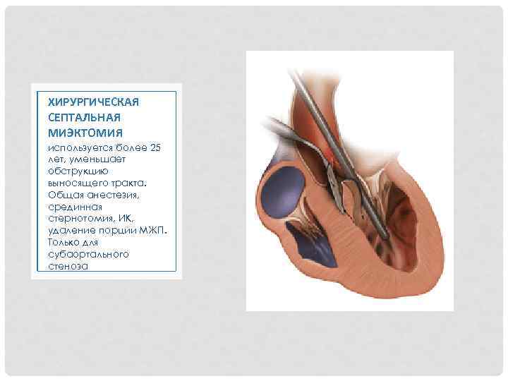 ХИРУРГИЧЕСКАЯ СЕПТАЛЬНАЯ МИЭКТОМИЯ используется более 25 лет, уменьшает обструкцию выносящего тракта. Общая анестезия, срединная