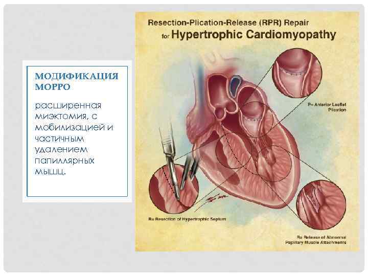 МОДИФИКАЦИЯ МОРРО расширенная миэктомия, с мобилизацией и частичным удалением папиллярных мышц. 