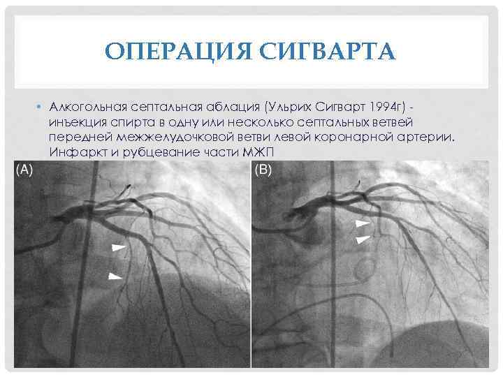 ОПЕРАЦИЯ СИГВАРТА • Алкогольная септальная аблация (Ульрих Сигварт 1994 г) инъекция спирта в одну