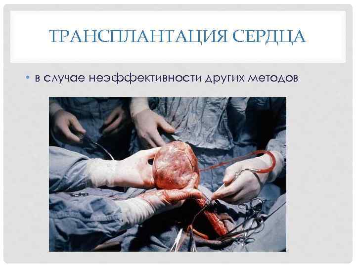 ТРАНСПЛАНТАЦИЯ СЕРДЦА • в случае неэффективности других методов 