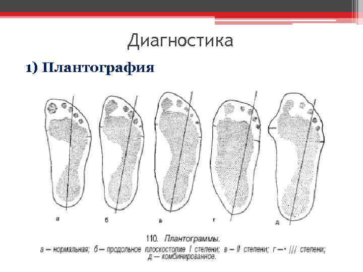 Диагностика 1) Плантография 