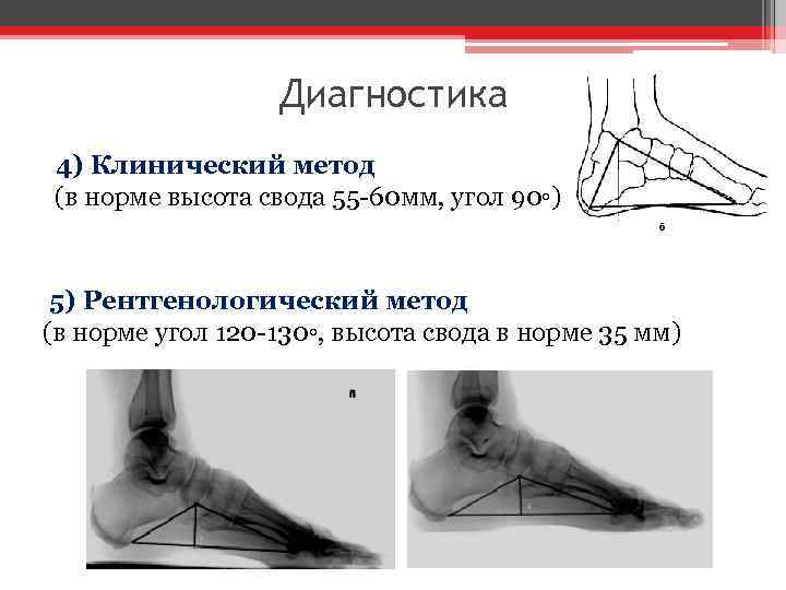 Диагностика 4) Клинический метод (в норме высота свода 55 -60 мм, угол 90◦) 5)