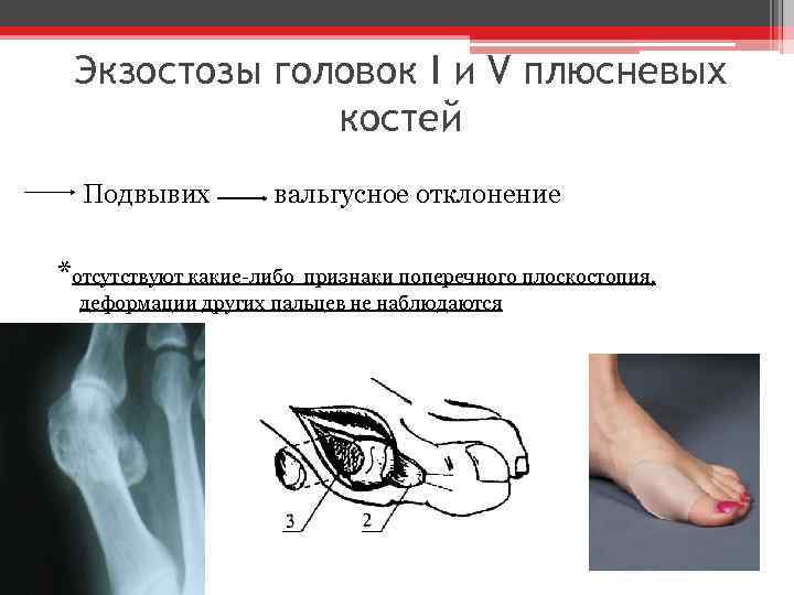 Экзостозы головок I и V плюсневых костей Подвывих вальгусное отклонение *отсутствуют какие-либо признаки поперечного