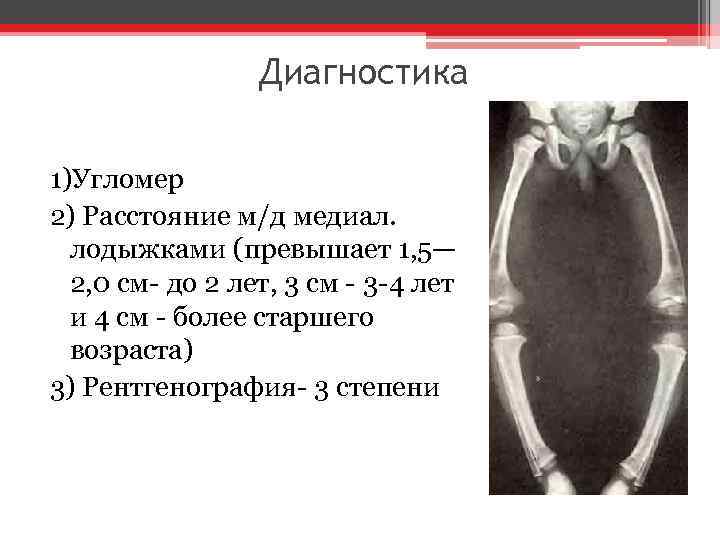 Диагностика 1)Угломер 2) Расстояние м/д медиал. лодыжками (превышает 1, 5— 2, 0 см- до