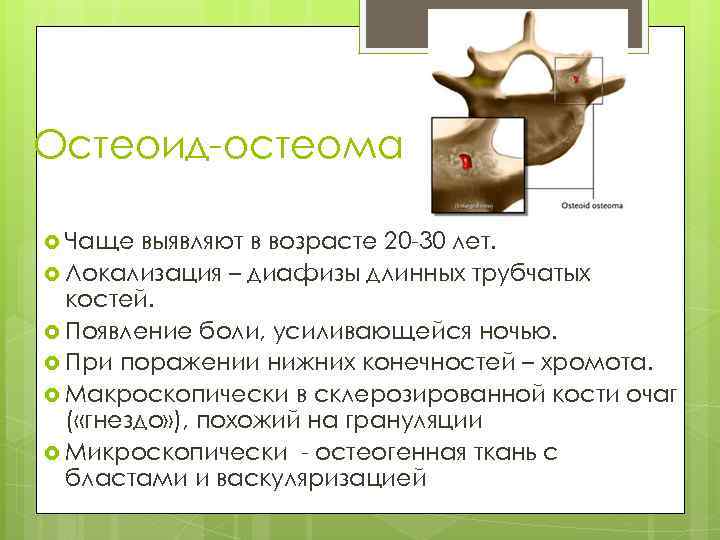Остеоид-остеома Чаще выявляют в возрасте 20 -30 лет. Локализация – диафизы длинных трубчатых костей.