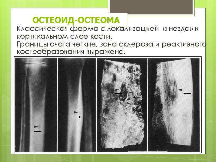 ОСТЕОИД-ОСТЕОМА Классическая форма с локализацией «гнезда» в кортикальном слое кости. Границы очага четкие, зона
