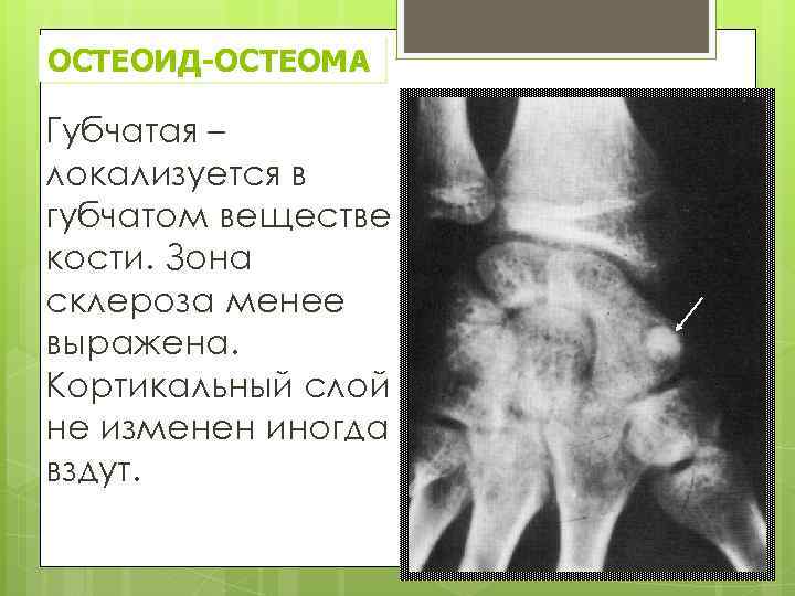 ОСТЕОИД-ОСТЕОМА Губчатая – локализуется в губчатом веществе кости. Зона склероза менее выражена. Кортикальный слой