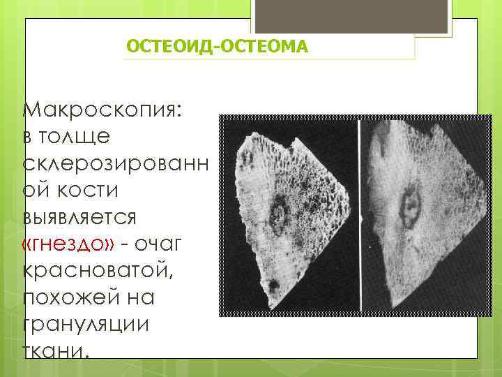 ОСТЕОИД-ОСТЕОМА Макроскопия: в толще склерозированн ой кости выявляется «гнездо» - очаг красноватой, похожей на